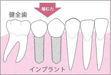 Sp インプラント 滋賀県草津市 南草津 十禅歯科クリニック 歯医者 審美歯科 ホワイトニング インプラント